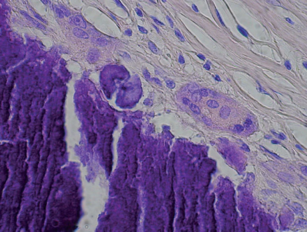 Histologický obraz – viacjadrová obrovská bunka na okraji depozít (HE, 600x)