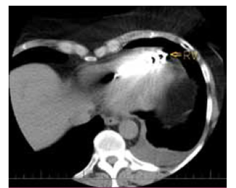 CT vyšetření hrudníku – hrot defibrilační elektrody pravděpodobně zasahuje mimo srdeční konturu, nelze však jednoznačně odlišit případnou perforaci myokardu od artefaktů způsobených elektrodou (RV – defibrilační elektroda).