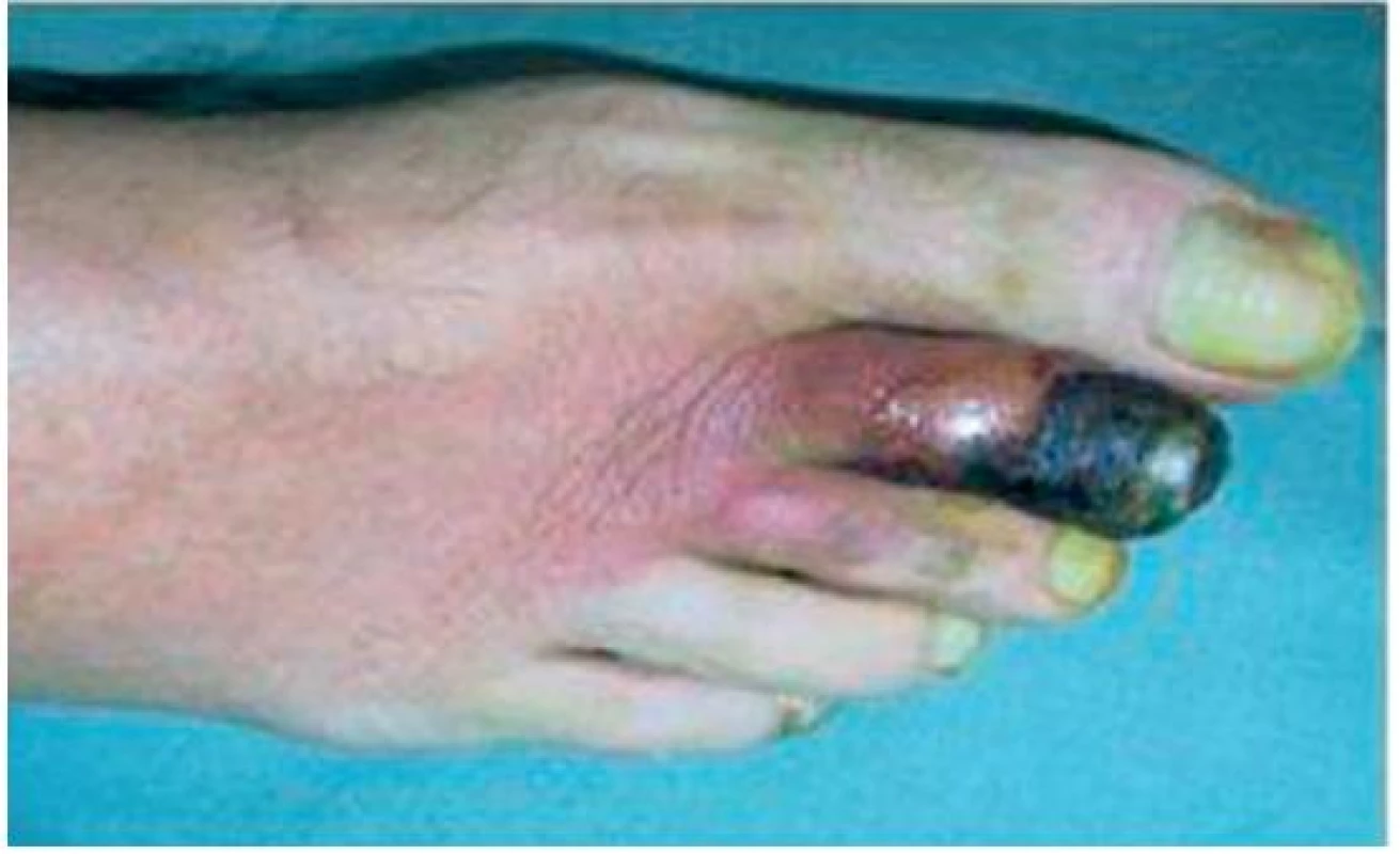Nekrotické změny na II. prstu PDK, stav před léčbou
