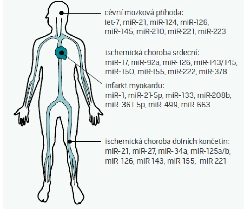 mikroRNA jako biomarkery aterosklerózy
Cirkulující mikroRNA je možné využít k diagnostice aterosklerózy a jejích manifestací – ať již cévní mozkové příhody, ischemické choroby srdeční, infarktu myokardu, či ischemické choroby dolních končetin.
Na obrázku jsou uvedeny jen vybrané mikroRNA, jejich plný výčet není z kapacitních důvodů možný. Je patrné, že některé miRNA jsou u všech podob aterosklerózy alterovány vždy – tyto pak pravděpodobně odrážejí přítomnost aterosklerózy jako takové. Jiné miRNA, např. miR-499, se v krvi běžně nevyskytují a dostávají se do ní až při nekróze buněk. Protože hladiny miRNA se mění vlivem medikace a různých komorbidit či rizikových faktorů (např. vlivem kouření), identifikace těch nejvíce specifických i senzitivních miRNA, které budou odrážet pouze přítomnost konkrétní nemoci a nic jiného, zůstává výzvou pro další výzkumníky v této oblasti.