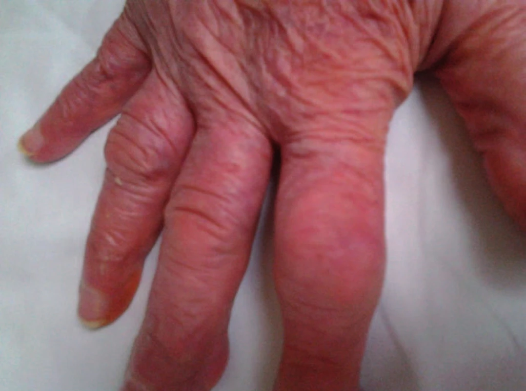 Dnavá artropatie u 87leté pacientky, postižení interfalangeálních kloubů.