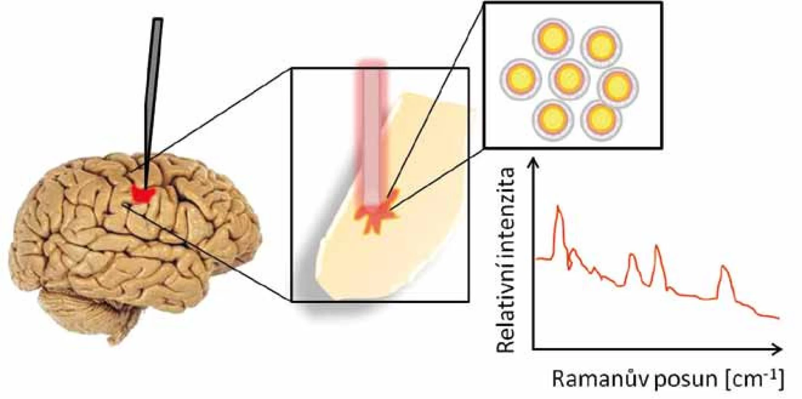 Detekce nádorových buněk mozku pomocí Ramanova skeneru.
Inertní zlaté nanočástice se kumulovaly v mozku v místě nádoru, byly detekovány sondou a zobrazeny v Ramanově spektru.