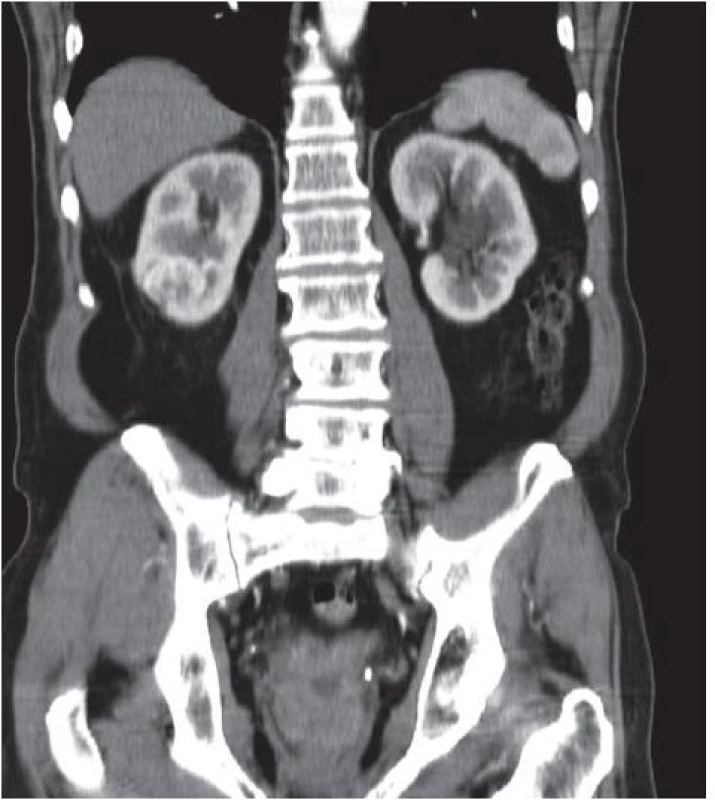 Tumor ledviny, CT snímek, arteriální fáze, koronární scan
Fig. 1. Renal tumor, CT image, arterial phase, coronar scan
