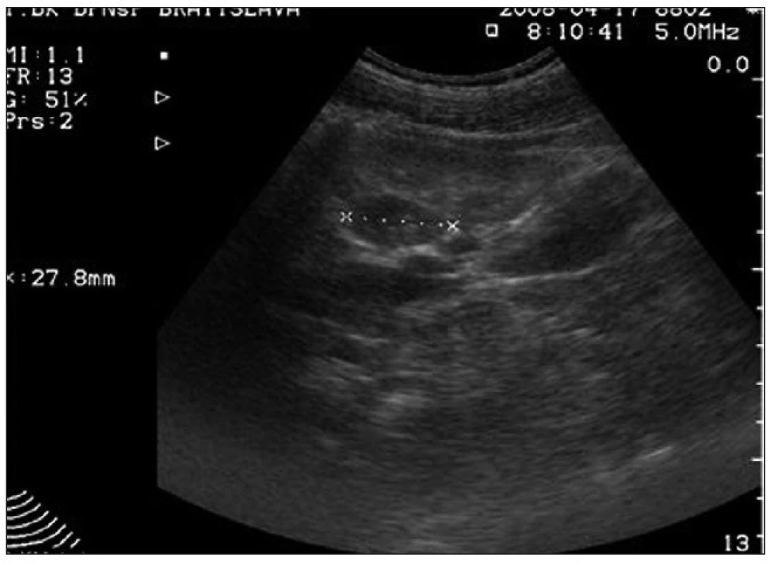 USG vyšetrenie po 16 dňoch: pretrváva len jedno hypoechogénne ložisko v pravej obličke.
Fig. 4. USG imaging after 16 days: only one hypoechogenic focus in the right kidney still remains.