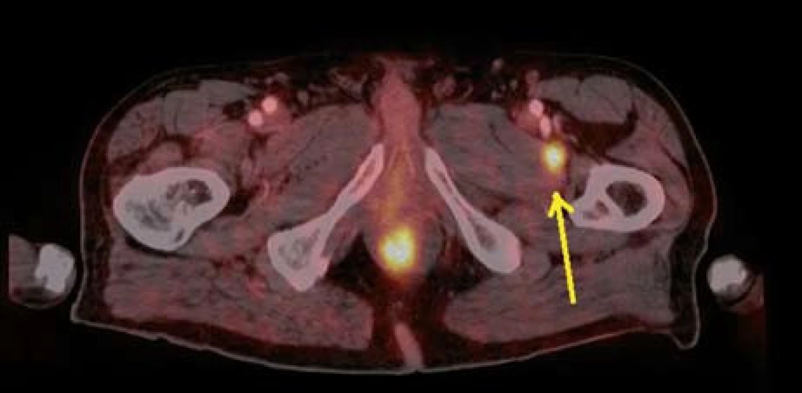PET CT – zvýšená akumulace FDG v adduktoru levého stehna – metastáza melanomu.
Fig. 11. PET CT – higher FDG accummulation in left adductor – melanoma metastasis.