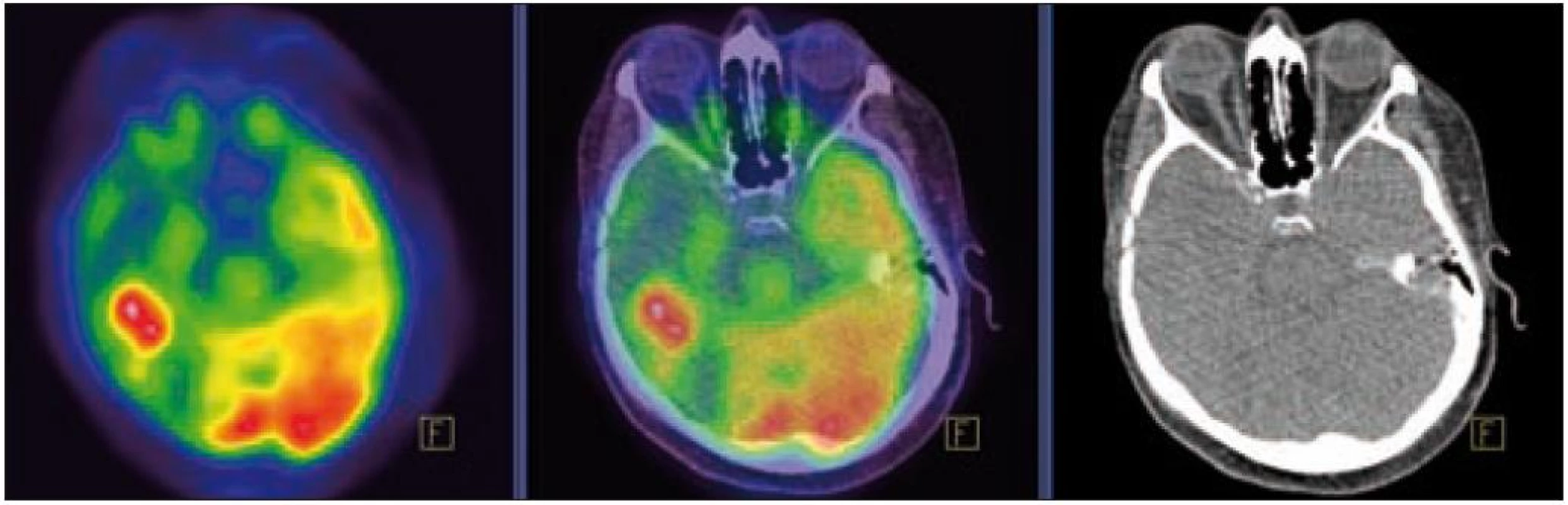 PET – Low-dose CT mozku. Ložisko vyšší akumulace FDG temporálně vpravo, SUV&lt;sub&gt;max&lt;/sub&gt; 12,53. Relativně nižší akumulace radiofarmaka v okolní kůře temporálního laloku vpravo.
