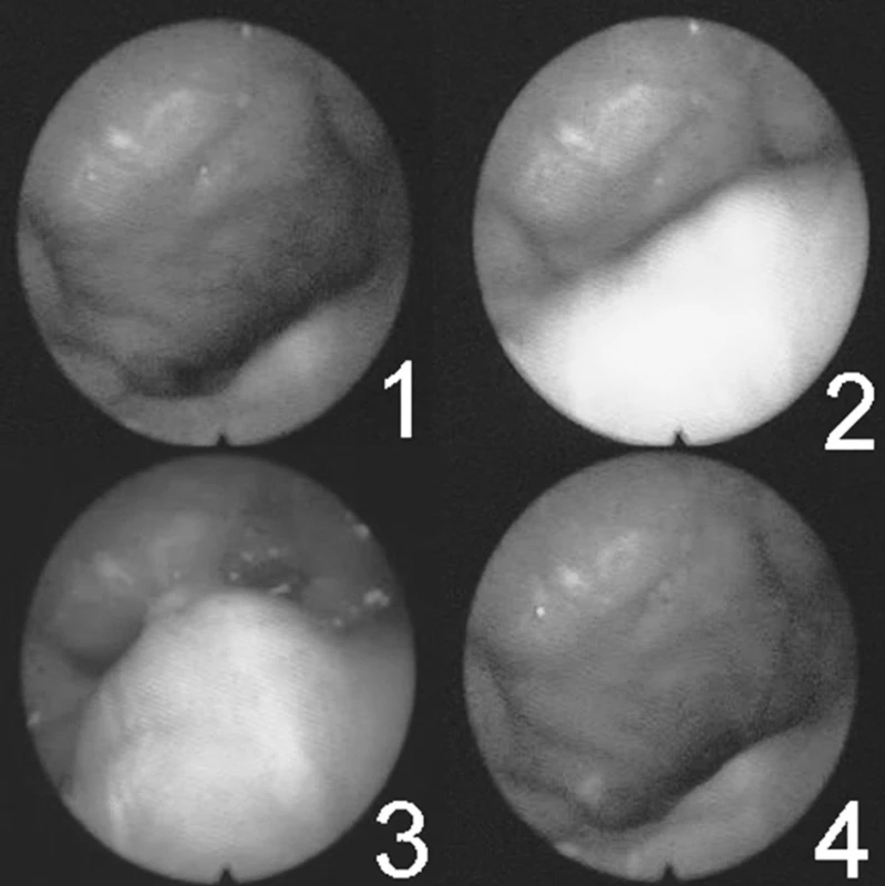 Série snímků zachycující pohyby velofaryngeálního uzávěru během polknutí (maximum uzávěru představuje číslo 3).