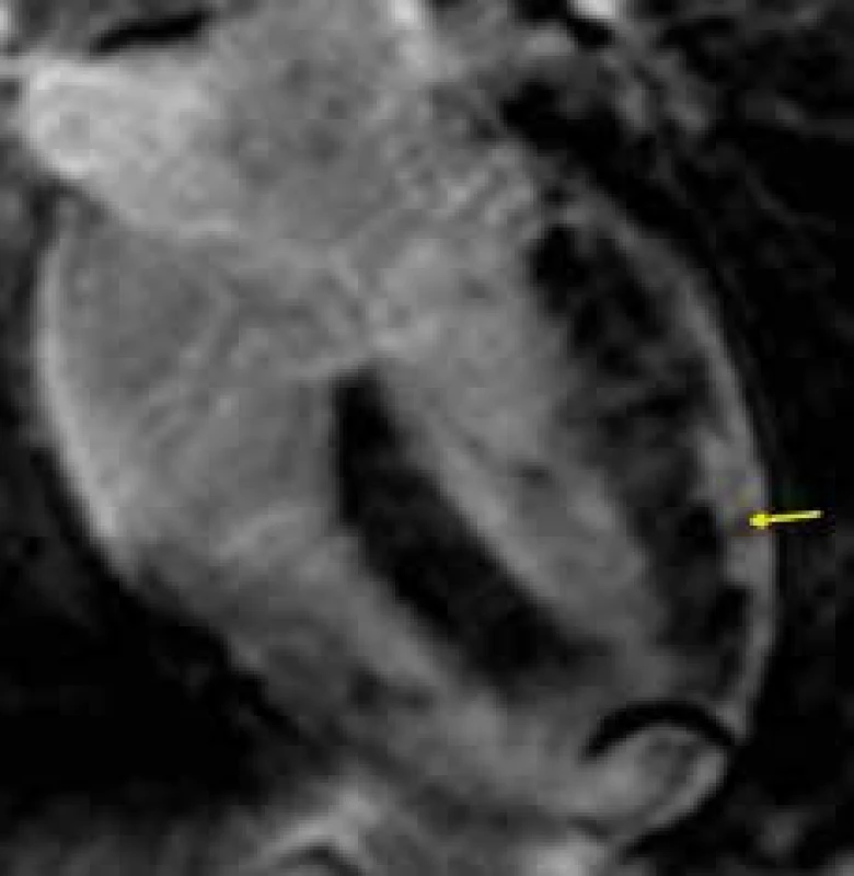 Subepikardiální splývavá ložiska pozdního sycení kontrastní látkou (LGE) na boční stěně levé komory (žlutá šipka) u nemocného s akutní myokarditidou; čtyřdutinová projekce
