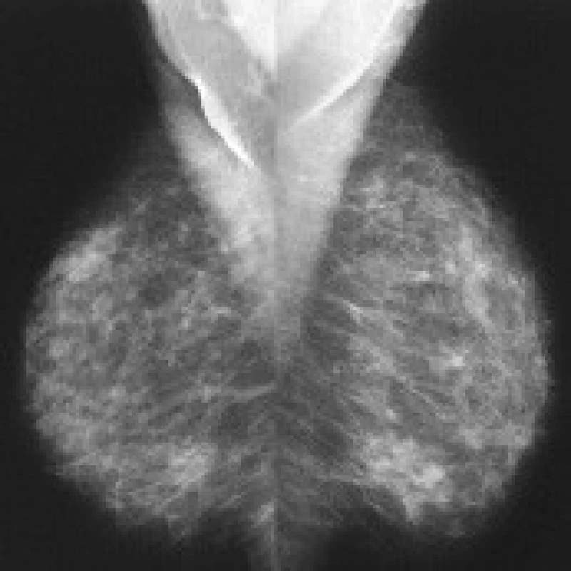 Nefrocystický snímek prsů: 55letá pacientka po roční léčbě tibolonem (2/2006).