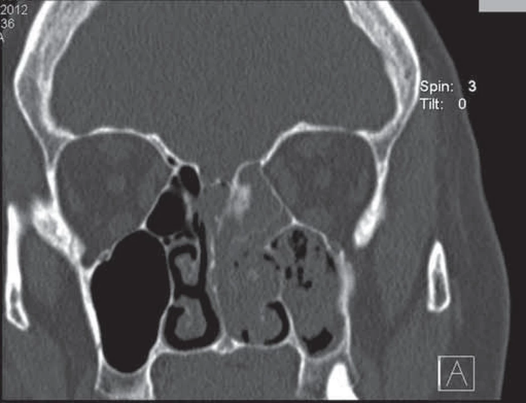 CT vyšetrenie prinosových dutín – koronárne rezy.