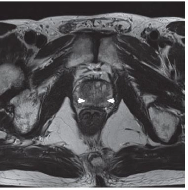 T2 vážené zobrazení – hypointenzivní ložiska tumoru (bílé šipky)
Fig. 1. Hypo-intense tumor regions of the both lobes of the prostate (white arrows) in T2 weighted MRI