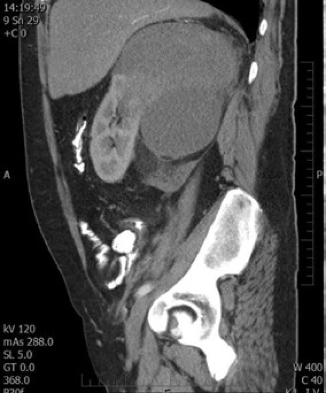 CT snímek tumoru
Fig. 2. CT of tumor