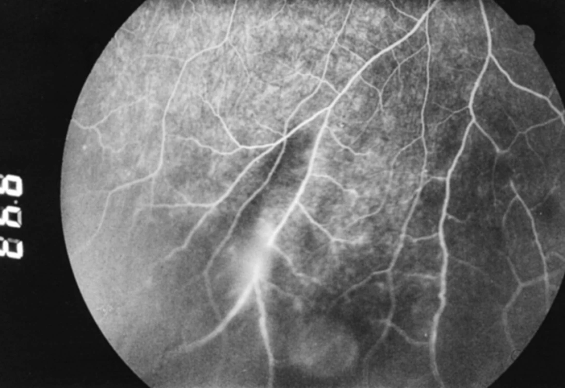 Fluoresceínová angiografia z 22. 3. 2004: a. v. shunty, a v neskorších fázach angiografie presakovanie farbiva z postihnutých ciev do okolitej sietnice
