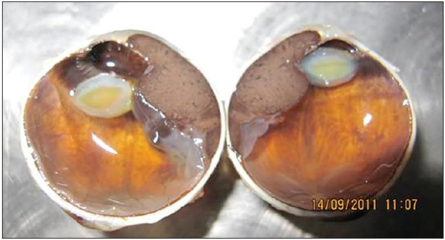 Malígny melanóm corpus ciliare v štádiu T3N0M0 so subluxáciou šošovky a prerastaním do prednej očnej komory