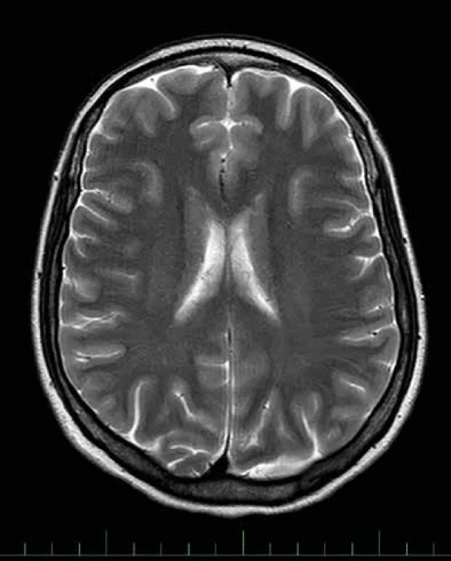 Snímek MR mozku s nespecifickými gliovými změnami u migrény (pacientka s chronickou migrénou s aurami, rok narození 1977)
