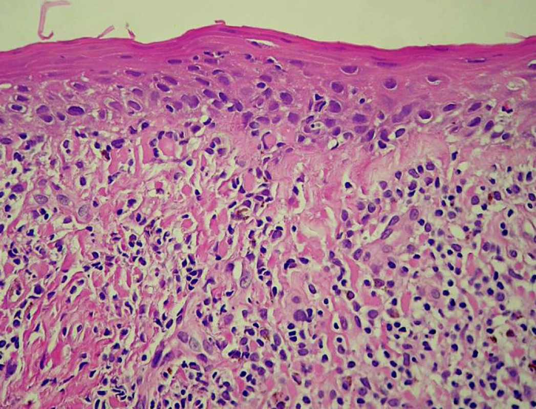 Kůže, zánětlivý infiltrát lichenoidního typu (hematoxylin – eozin, objektiv 40×)