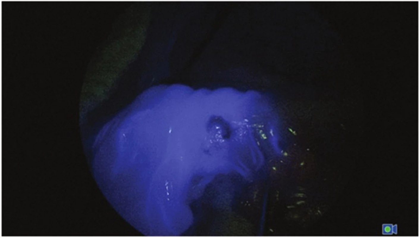 Střevní segment po aplikaci ICG (modrá – tkáň s optimální perfuzí)
Fig. 2: Bowel segment after ICG aplication (blue – tissue with optimal perfusion)