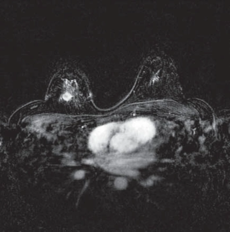 MR-snímek prsu – vlevo fyziologické sycení žlázy, vpravo ložisko tumoru