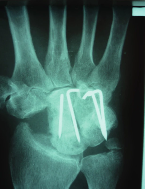 Rentgenový snímek zápěstí po mediokarpální artrodéze a exstirpaci os scaphoideum