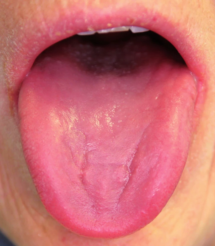 Vyhlazení papil jazyka při sideropenické anémii