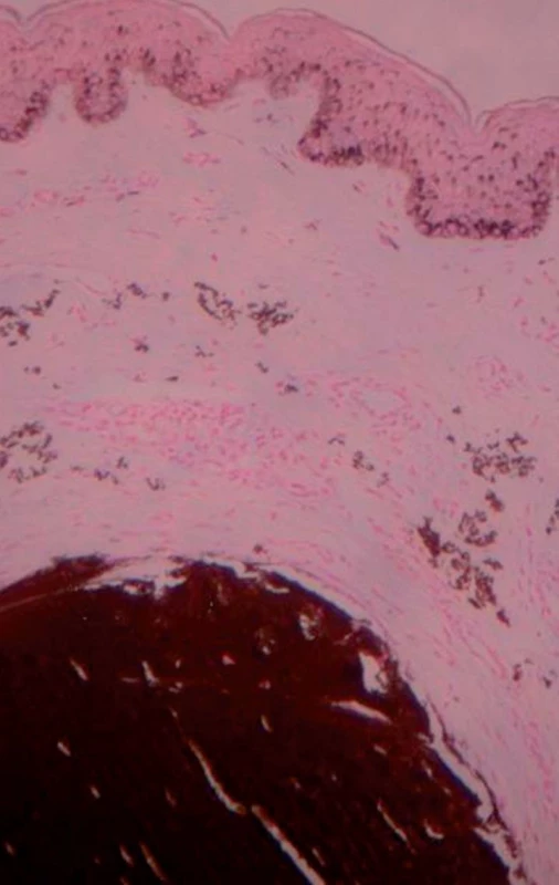 Histopatologický obraz – farbenie von Kosa, zväčšenie: 20x – krátke, skrútené elastické vlákna v retikulárnej dermis nad veľkým depozitom kalcia.