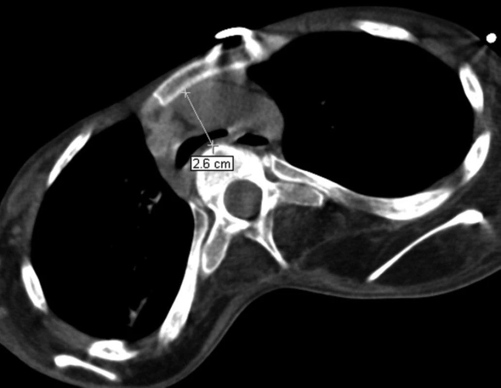Porovnání ventrodorzální šíře horního mediastina v referenční úrovni aortálního oblouku v dubnu 2008 – šíře 26 mm