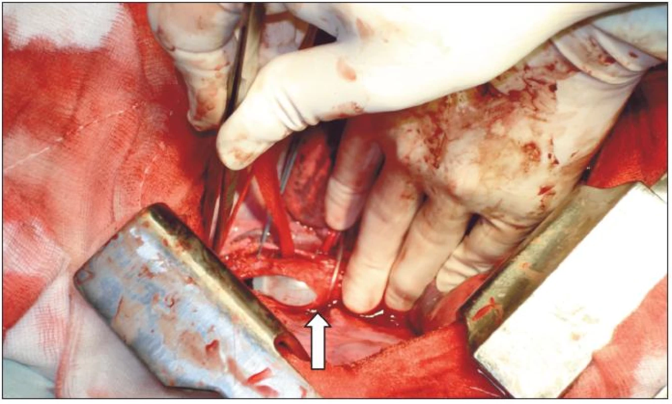 První případ, operační nález. Z pravostranné torakotomie po protětí mediastina a částečné rotací trachey byla potvrzena asi 35 mm dlouhá ruptura pars membranacea s patrným balonkem tracheální rourky (šipka).
