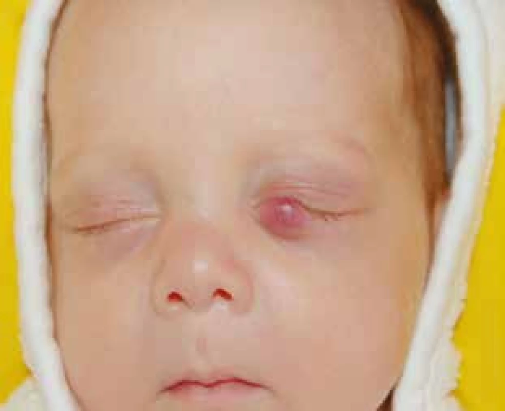 Infantilní hemangiom dolního víčka ohrožující vizus.
Fig. 5. Infantile hemangioma of the lower eyelid threatening vision ability.