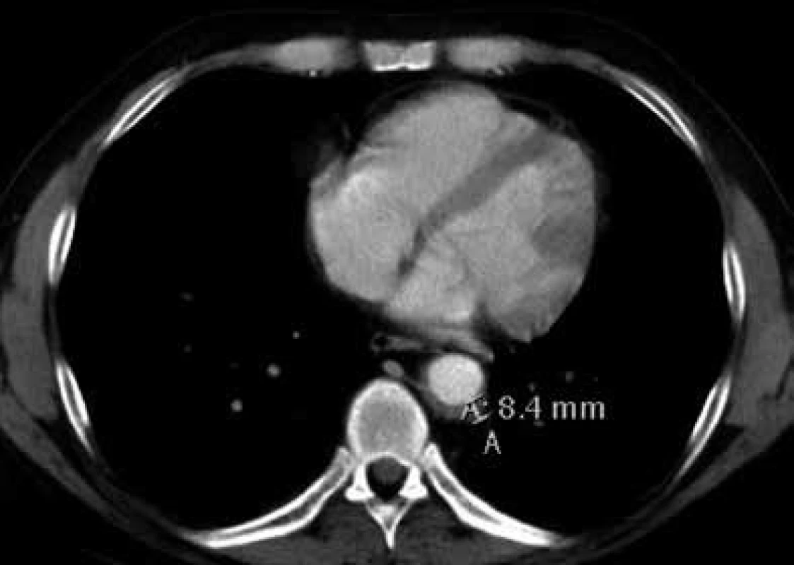 Postkontrastní CT vyšetření hrudníku, axiální rovina
Nepravidelně zesílená stěna sestupné hrudní aorty dosahuje šíře 8,4 mm.