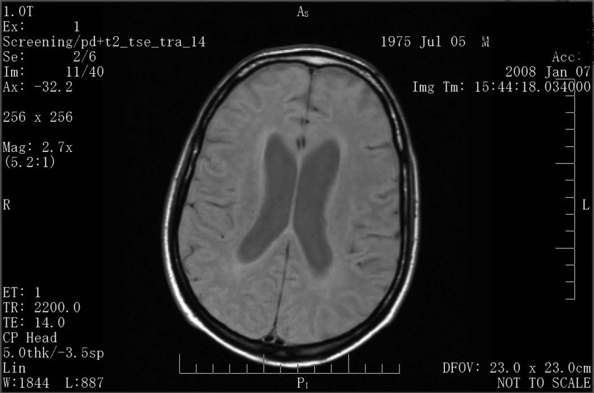 MR mozku – povšechná atrofie a víceložiskové postižení bílé hmoty jako obraz HIV encefalopatie