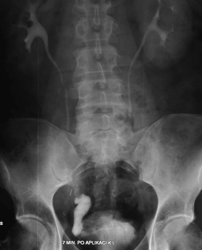 Ortotopická neovezika u muže – vylučovací urografie.