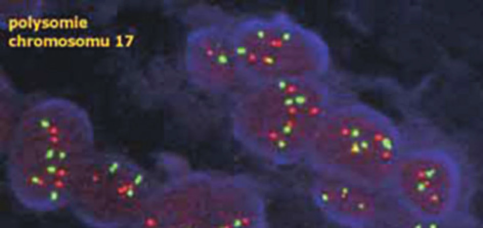 V případě polysomie chromozomu 17 je zvýšen nejen počet červených signálů genu HER2, ale také počet červených centromerických signálů – poměr mezi však zůstává obdobný jako u normálních buněk (dle www.patologie.info.cz)