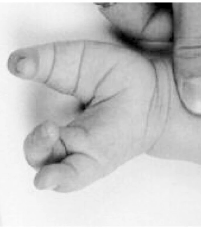 Oboustranný syndrom femur, tibie, radius spojený s rozštěpem ruky (klepetovitá ruka) a redukcí paprsků prstů obou rukou. Jedná se o rozštěpovou vadu horních končetin, etiopatogeneticky podobnou s rozštěpy patra a páteře (midline defekt). Může být součástí syndromu asociace rozštěpů.