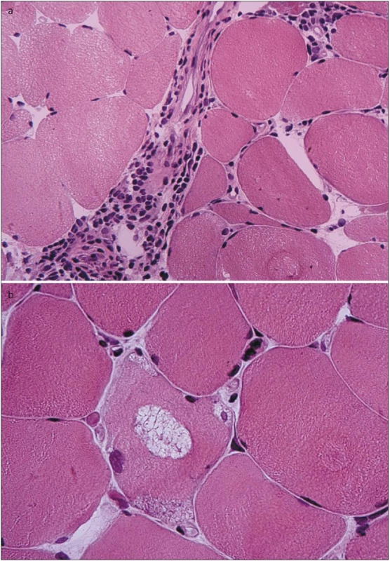 Nahoře: perimysiální i endomysiální lymfocytární infiltrace (HE, zvětšení 400×). Dole: lemované vakuoly obsahující jemně granulární bazofilní materiál (HE, zvětšení 600×).