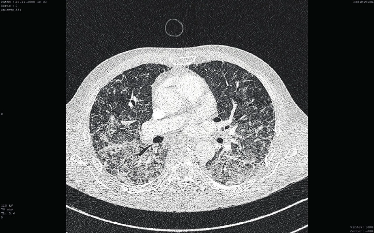 Kontrolní CT vyšetření plic (cca po 7 dnech)