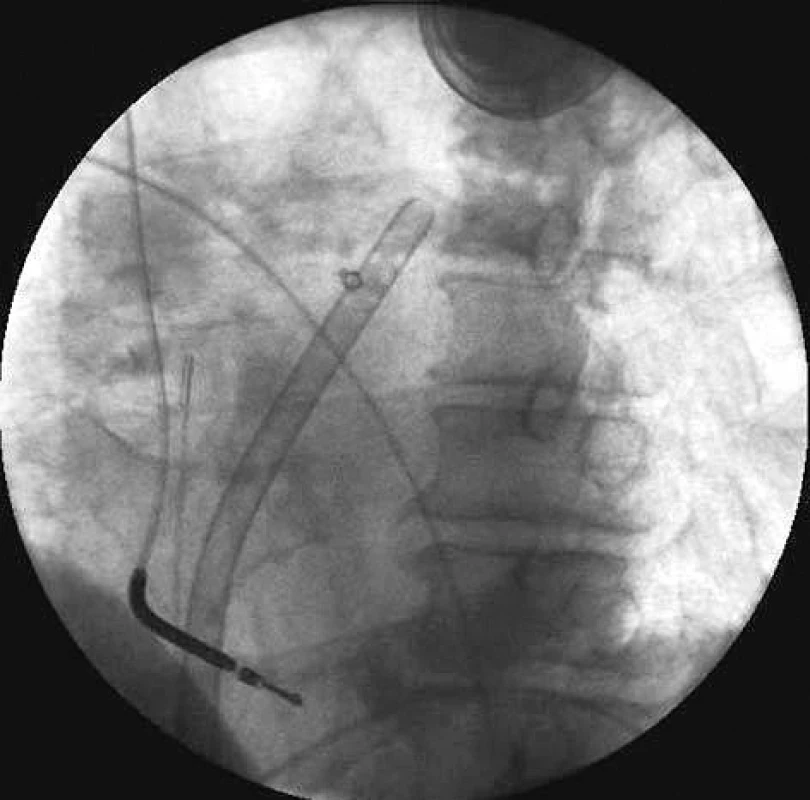 A – systém Tandem Heart (schéma zapojení k levostranné podpoře) – přívodná kanyla zavedená transseptálně v levé síni, odvodná kanyla zavedena do descendentní aorty; B – skiagram hrudníku s nasávací kanylou zavedenou do levé síně, patrný průběh kardiostimulačního systému
