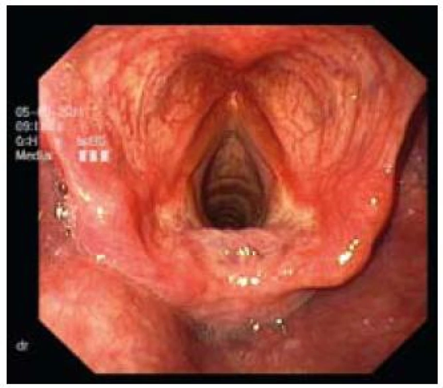 Těžká forma laryngitidy.
Fig. 12. Severe laryngitis.