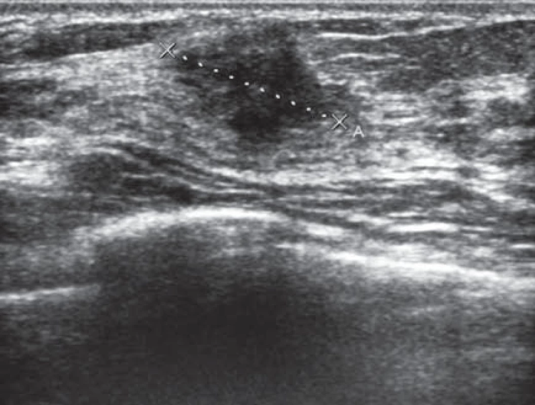 Ultrasonografi cký obraz zhoubného nádoru prsu – hypoechogenní ložisko s nepravidelnou konturou