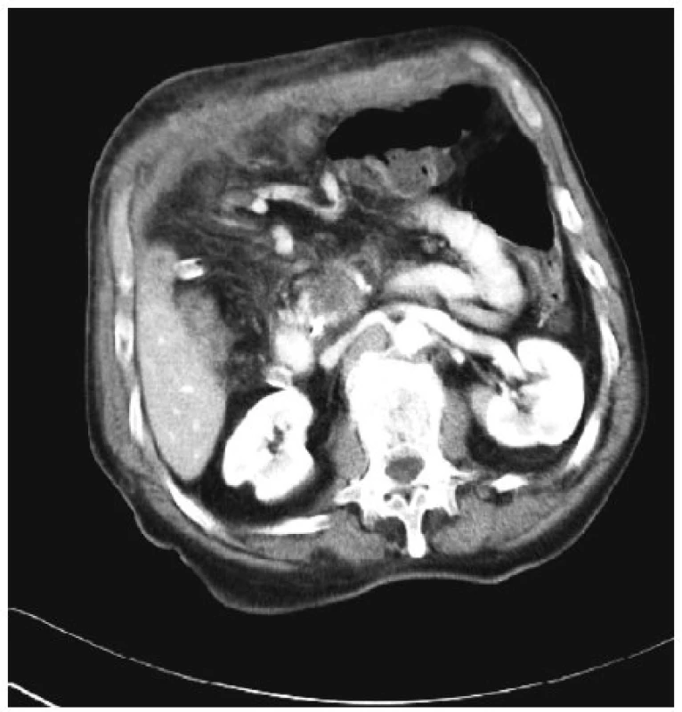 Tentýž tumor těla pankreatu 7 dní po RFA
Fig. 4. The same tumor of the pancreatic head 4 days after the RFA procedure