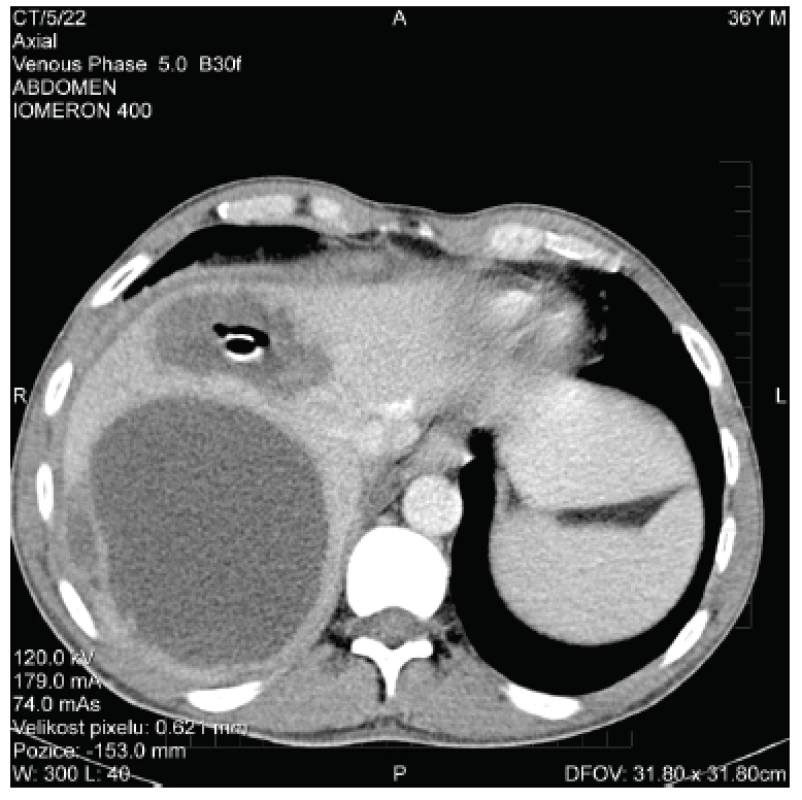 CT obraz jaterních abscesů po chirurgické drenáži
Fig. 2. CT scan of liver abscesses after surgical drainage