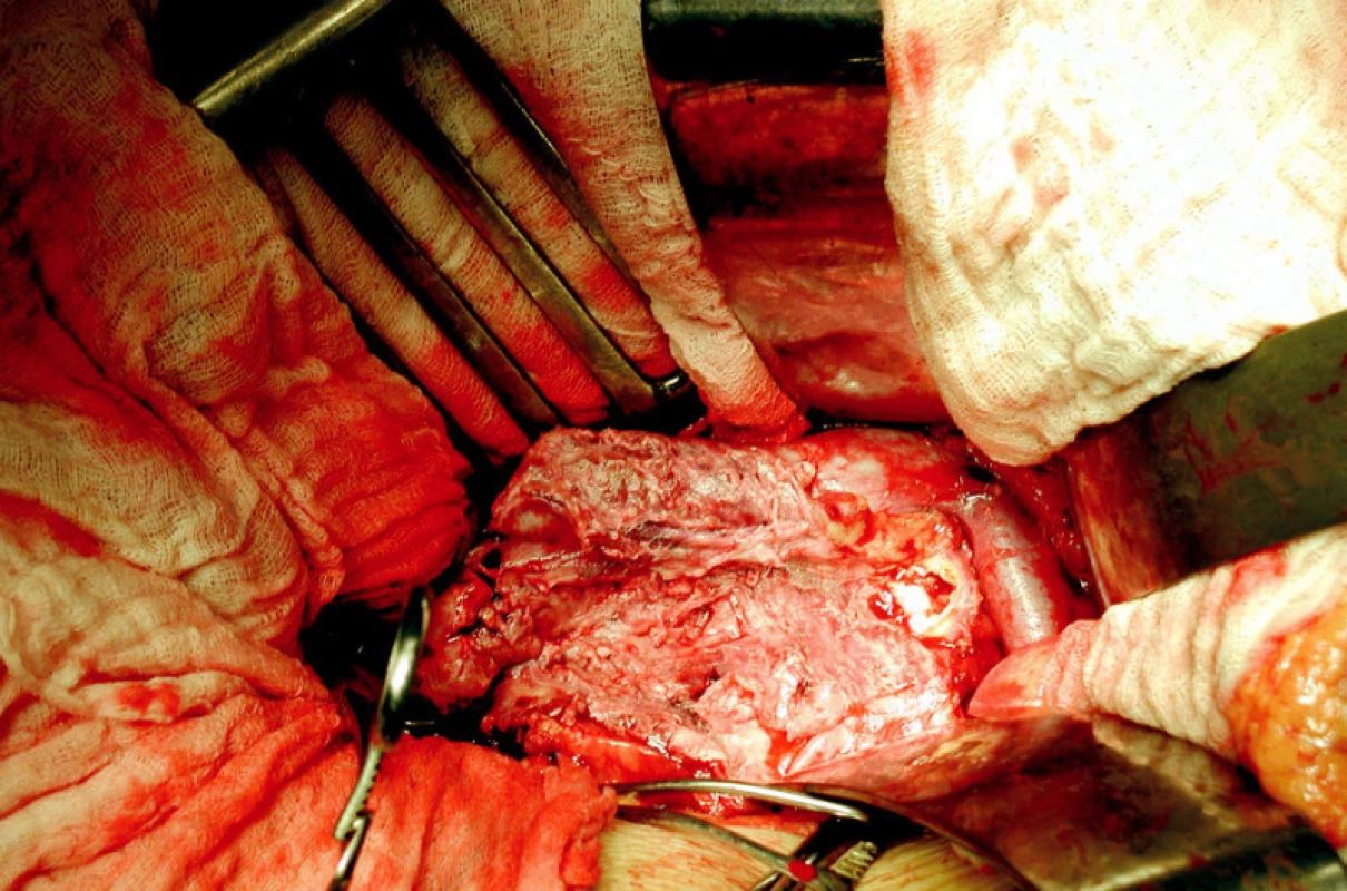 Resekce subrenálního mykotického aneuryzmatu abdominální aorty
Fig. 3. Resection of the mycotic aneurysm of the infrarenal abdominal aorta