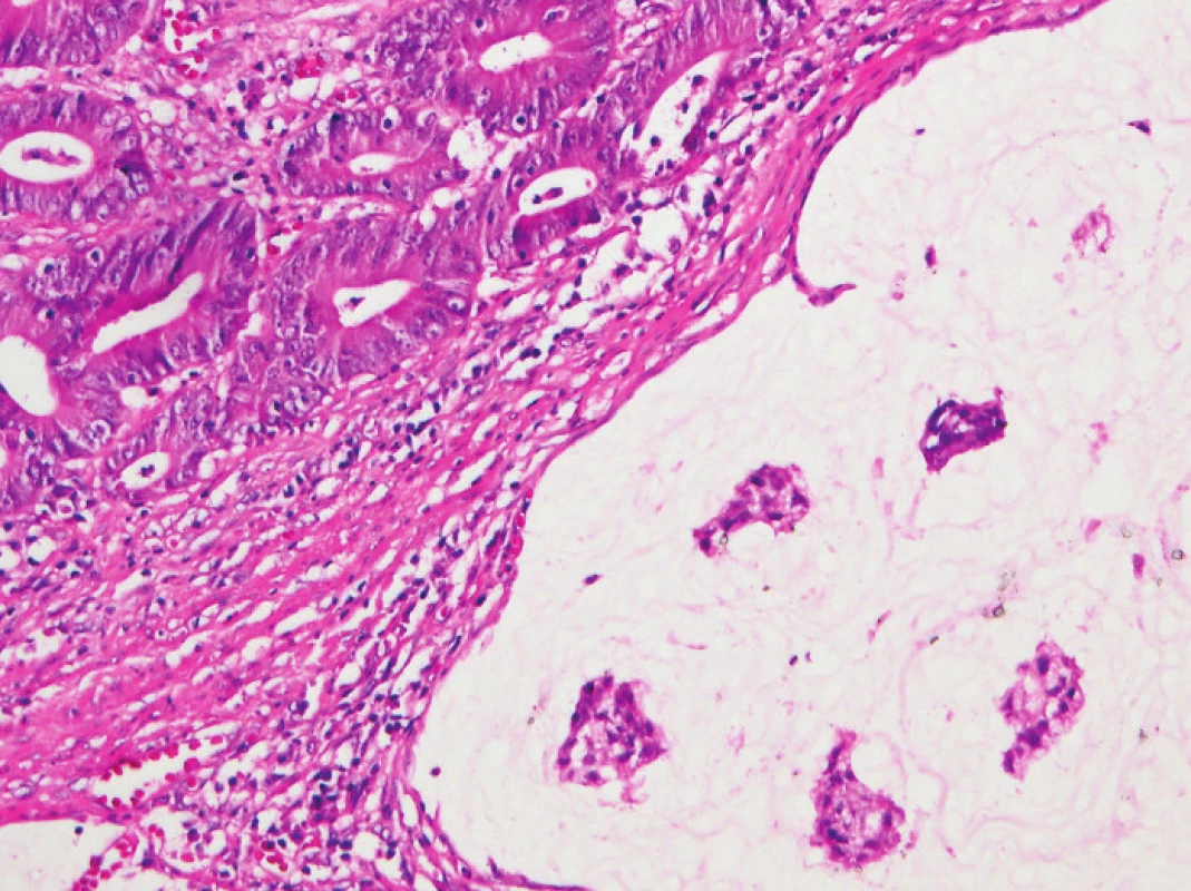 V dolní části obrázku je patrný hlen dissekující stroma a vytvářející hlenové jezírko. V hlenu plavou ostrůvky nádorových buněk. V horní části obrázku je zřetelně vidět „posypání“ nádorových žlázek lymfocyty obklopenými světlými halo (HE, původní objektiv 10x).