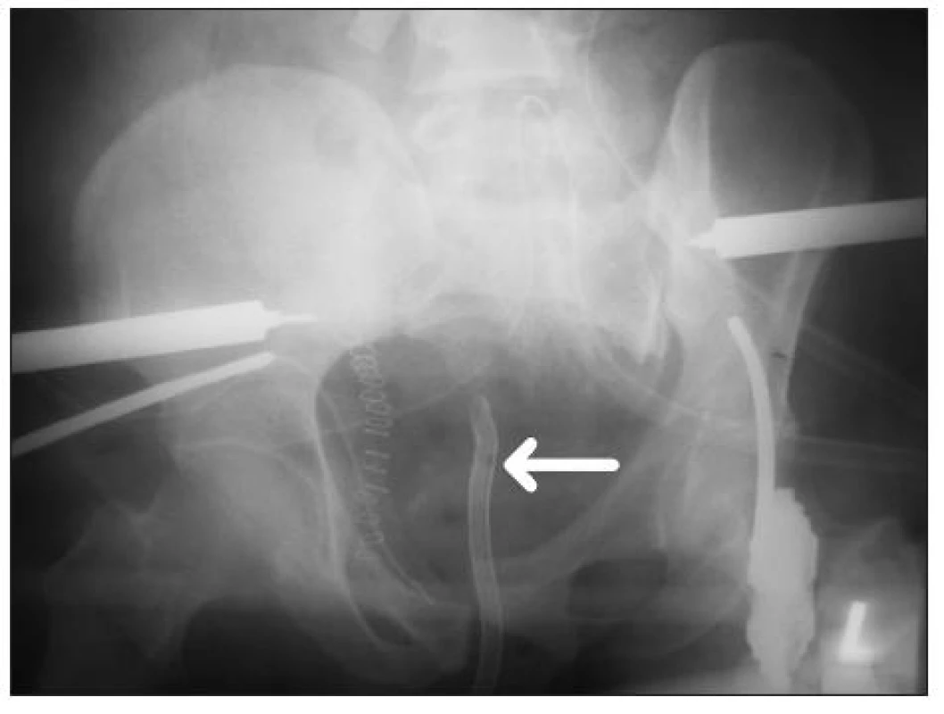RTG snímek pánve po primární stabilizaci zlomeniny zevní fixací a pánevní svorkou. RTG kontrastní Dufourův močový katétr označen šipkou
Fig. 1. X-ray picture of the pelvis after primary stabilisation by external fixator and pelvic C-clamp. Dufour catheter visible in X-ray picture is marked with arrow