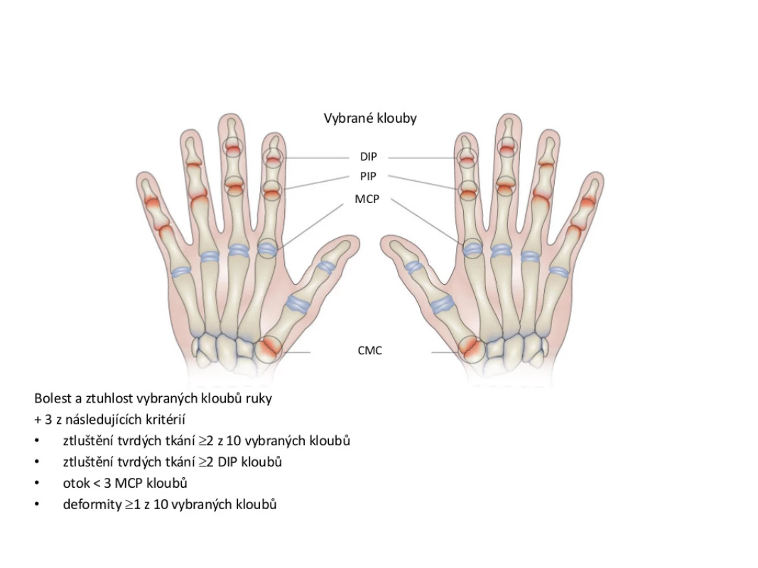 Klasifikační kritéria osteoartrózy (OA) rukou podle Americké revmatologické asociace &lt;em&gt;(upraveno dle: Altman et al., 1990)&lt;/em&gt;