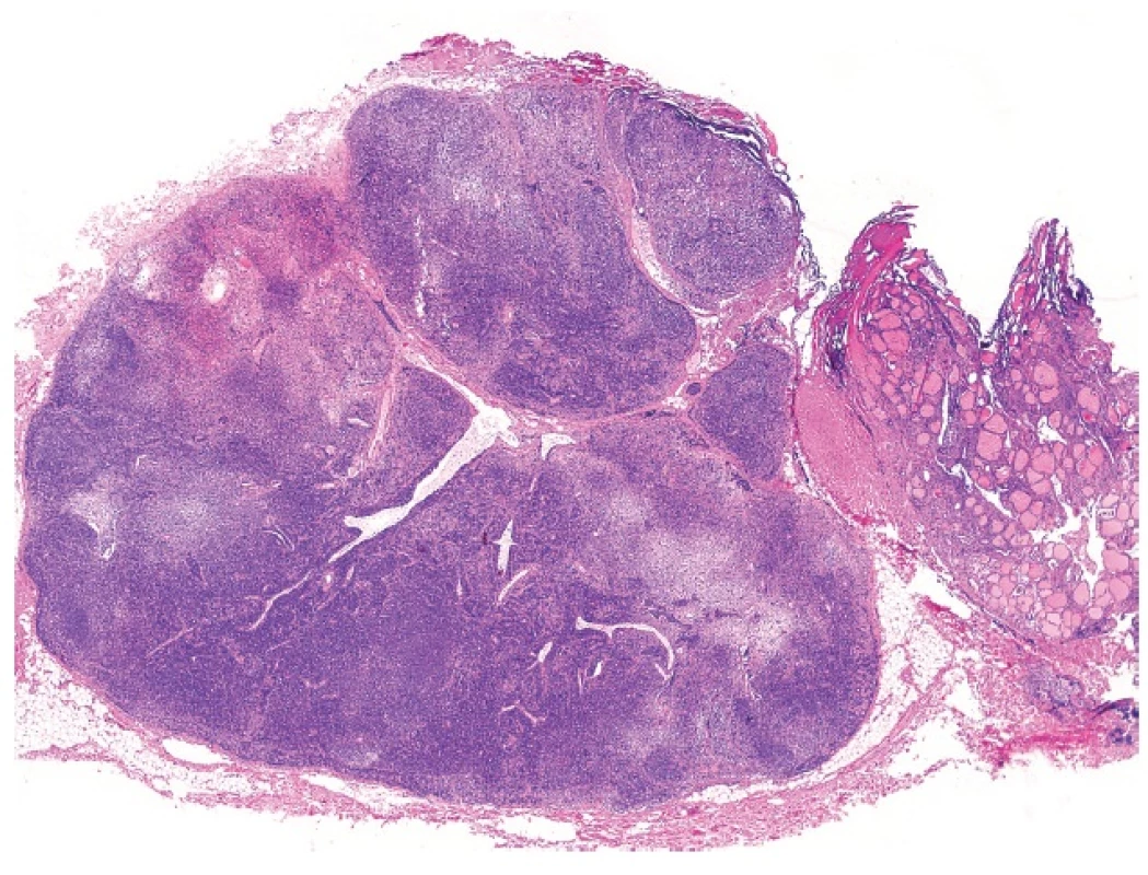 Sequestered thyroidal nodule juxtaposed to a lymph node simulating a metastatic thyroid carcinoma (magnification 20x).