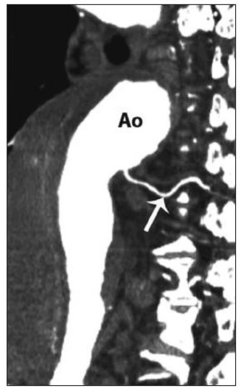 Odstup Adamkiewiczovy tepny (magnetická rezonance, Ao – aorta)
Fig. 7. Adamkiewicz artery branching (magnetic resonance, Ao – aorta)