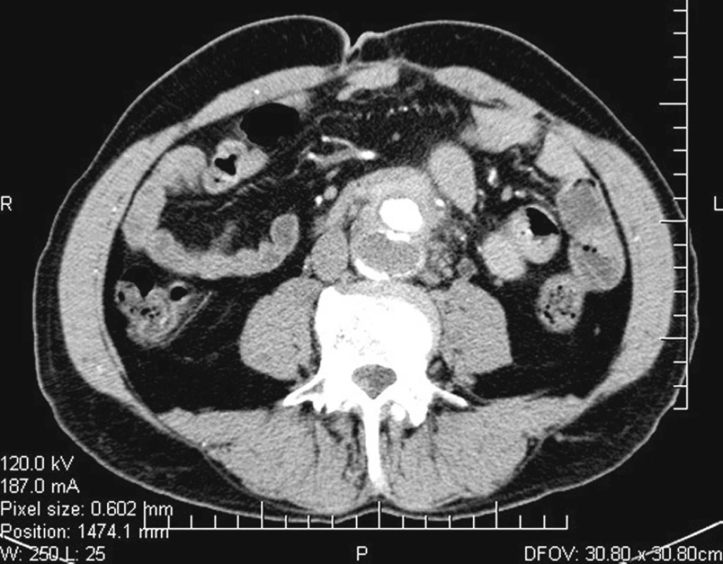 Předoperační CT: lem v místě anastomózy cévní protézy k aortě šíře do 1 cm
Fig. 1. Preoperative CT: 1 cm wide margin at the point of the upper anastomosis