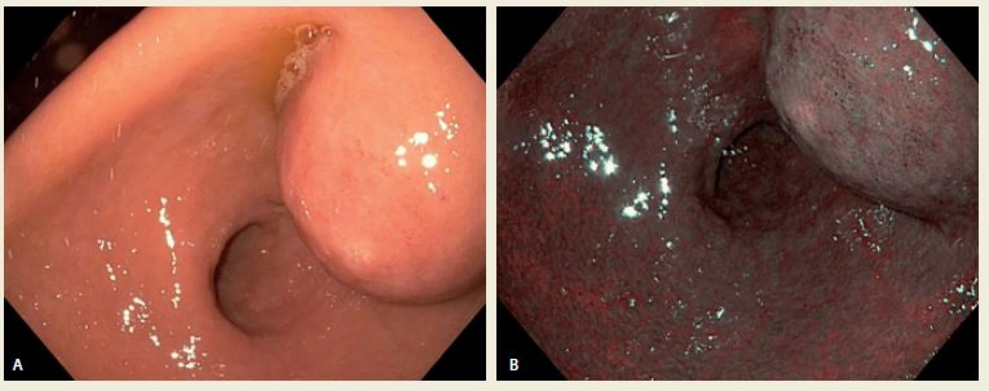 A,B. Gastroskopický obraz a – v normálním světle a b – pod NBI (Narrow Band Imaging).<br>
Fig. A,B. Antral intramural tumor in normal and NBI (Narrow Band Imaging).