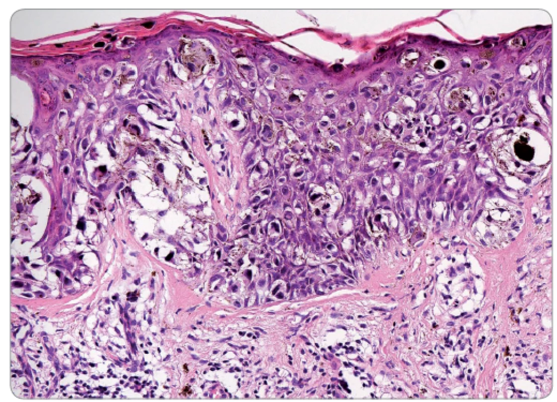 Histologický vzhled povrchově se šířícího melanomu – vysoce atypické melanocyty prorůstají celou tloušťkou epidermis až k povrchu, buňky jsou patrny i ve stratum corneum. V dermis je patrný chronický zánětlivý infiltrát (hematoxylin-eosin; 200×).