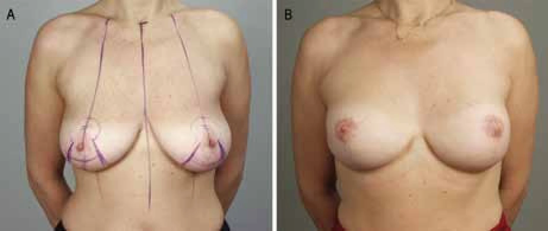A. Zdravá BRCA1-pozitivní pacientka před oboustrannou subkutánní mastektomií s modelací; 2B. Po rekonstrukci implantáty.